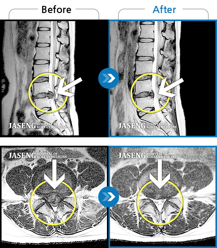 자생한방병원 치료사례 MRI로 보는 치료결과-일상생활 불가능한 통증으로 본원에 입원 위해 내원