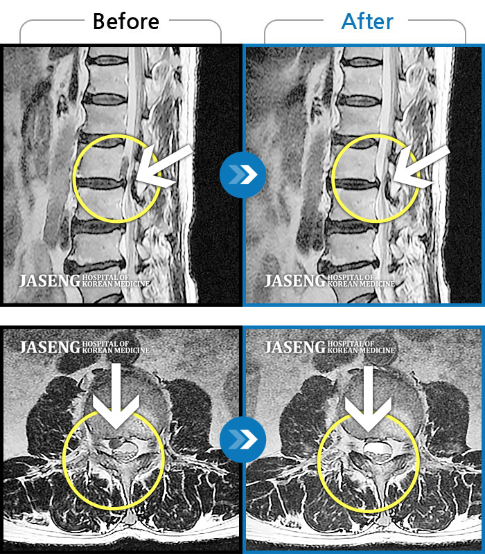자생한방병원 치료사례 MRI로 보는 치료결과-오른쪽 허리가 많이 아팠고, 오른쪽 다리가 남의 살처럼 먹먹했다.