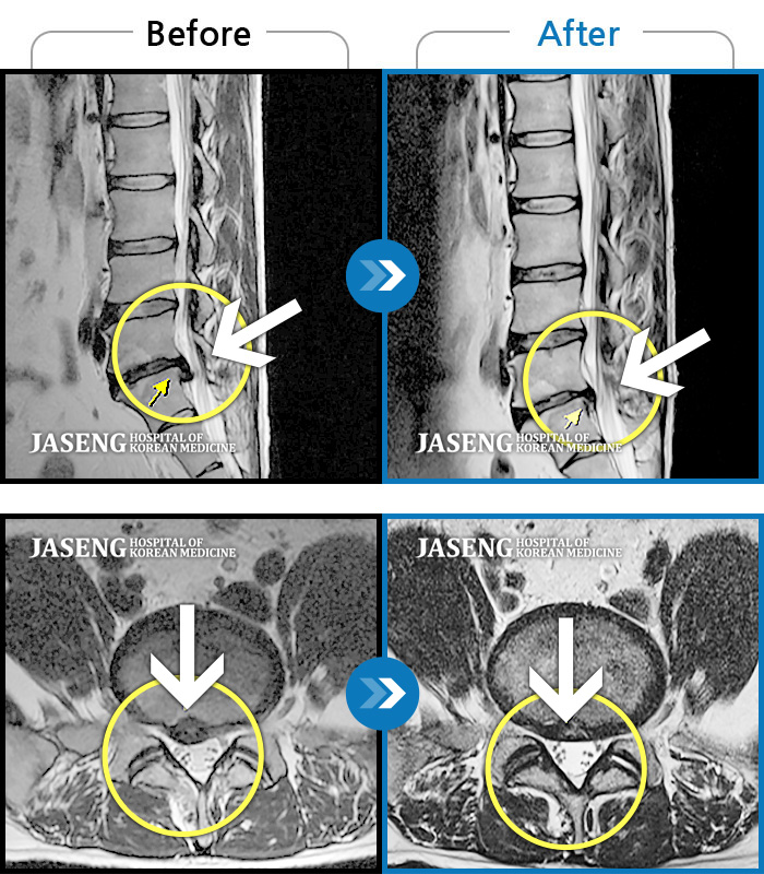 자생한방병원 치료사례 MRI로 보는 치료결과-우측 허리 및 하지 전반적인 통증과 저린감