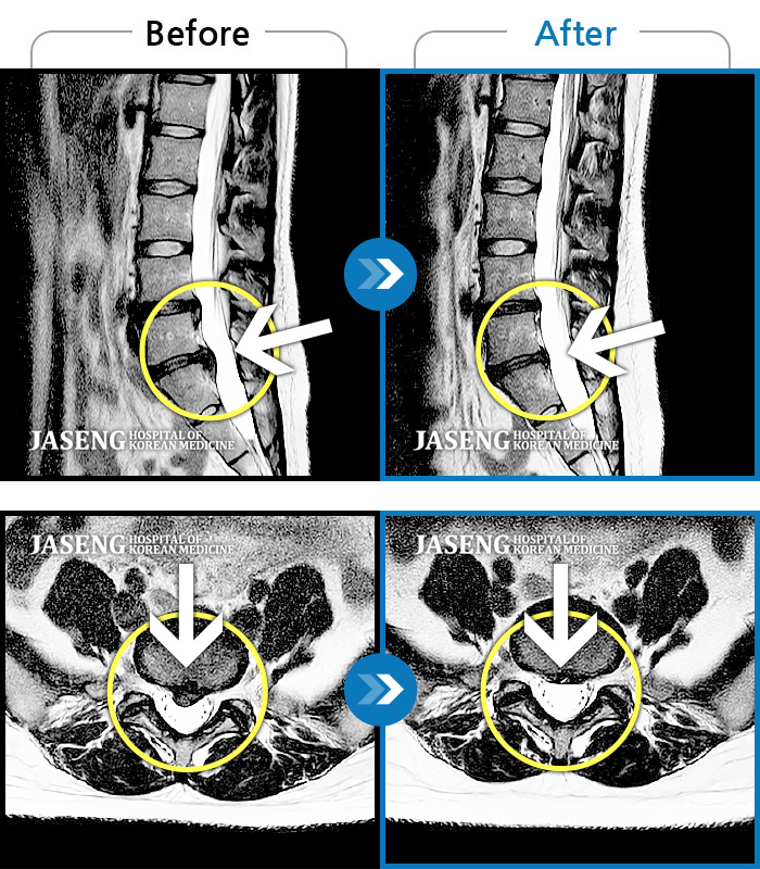 자생한방병원 치료사례 MRI로 보는 치료결과-허리통증 심하고 양하지 통증 있어요. 