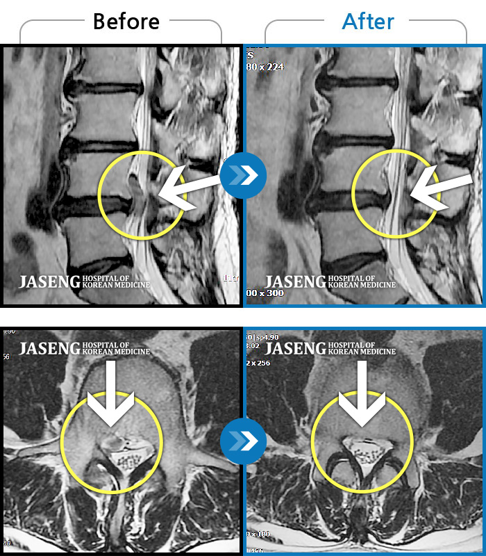 자생한방병원 치료사례 MRI로 보는 치료결과-우측이 주로 뻐근하고 뭉친 느낌이 든다. 앉아있으면 허리가 묵직하고 목에도 무리가 와서 앉아 있을 수가 없음. 