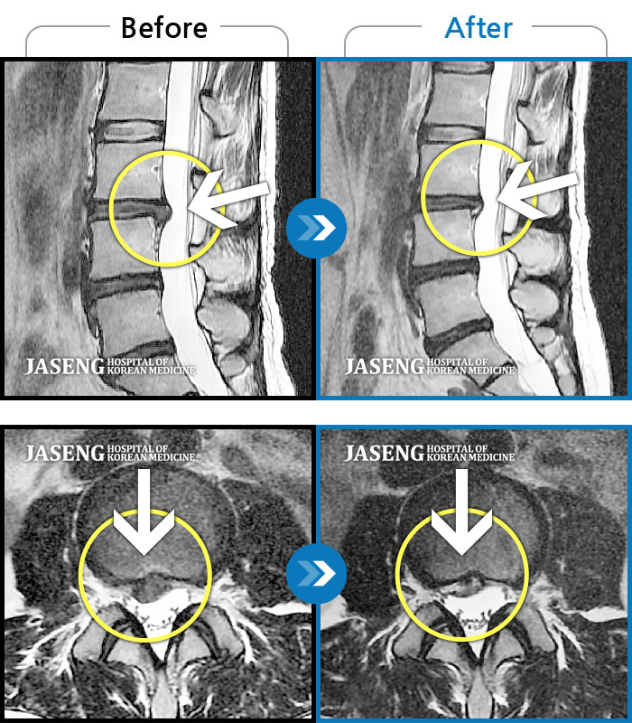 자생한방병원 치료사례 MRI로 보는 치료결과-짐을 들면서 정리하다가 디스크가 터져서 내원, 후에 통증이 더 심해져 내원 