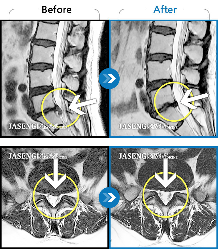 자생한방병원 치료사례 MRI로 보는 치료결과-허리가 펴지지 않는 상태로 진통제 없이는 보행이 불가능한 상태