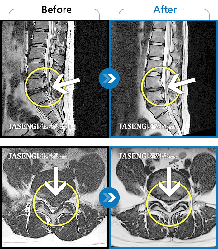 자생한방병원 치료사례 MRI로 보는 치료결과-넘어져서 허리디스크가 터진 후 꼼짝도 못할만큼 심하게 아팠었다.