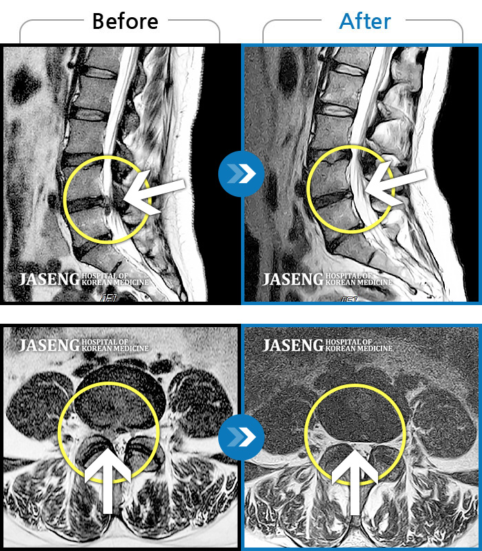 자생한방병원 치료사례 MRI로 보는 치료결과-거꾸리 하고 난 후 허리통증과 하지마비로 일어날 수 없었습니다.