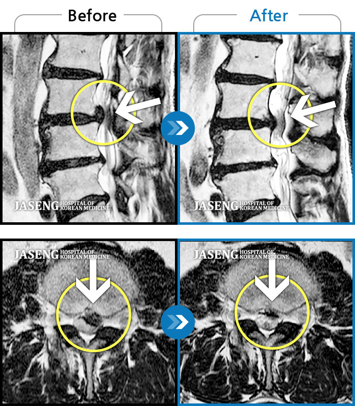 자생한방병원 치료사례 MRI로 보는 치료결과-회사에서 무거운 물건을 들다가 디스크가 터졌습니다.
