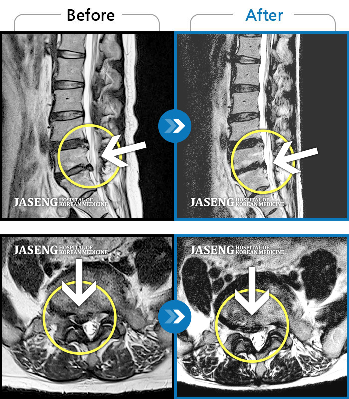 자생한방병원 치료사례 MRI로 보는 치료결과-허리, 둔부 및 다리로 통증과 저림이 심해서 옆으로 잘 수 없어요.