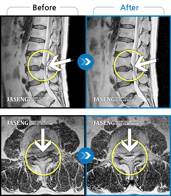 자생한방병원 치료사례 MRI로 보는 치료결과-양 허리와 다리가 아프고 걸을때 다리 통증으로 걷기 어려웠다