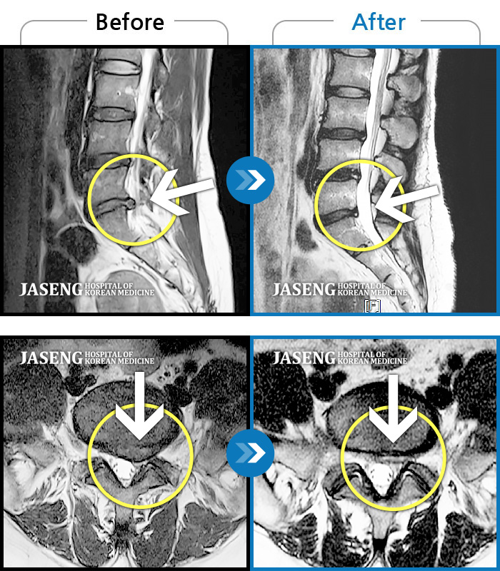 자생한방병원 치료사례 MRI로 보는 치료결과-허리 통증과 왼쪽 다리 저림이 너무 심해서 걷기도 잠자기도 힘들었어요