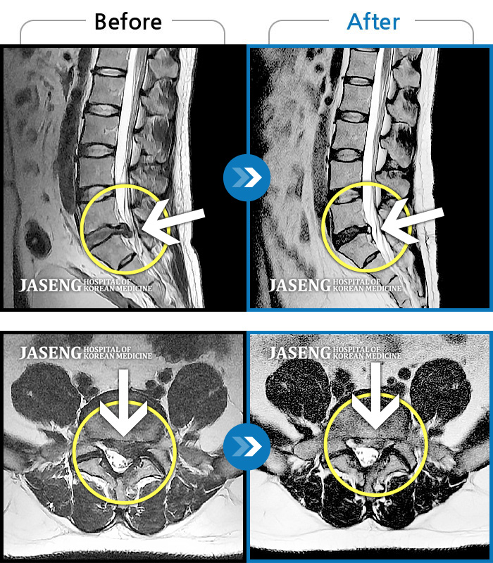 자생한방병원 치료사례 MRI로 보는 치료결과-허리와 좌측 다리 통증저림이 심하고 발목 힘이 빠져요. 