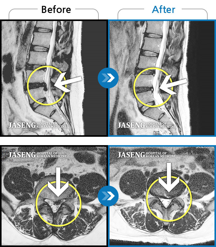 자생한방병원 치료사례 MRI로 보는 치료결과-허리 통증과 다리 저림이 심해 걷지도 앉지도 못하겠어요