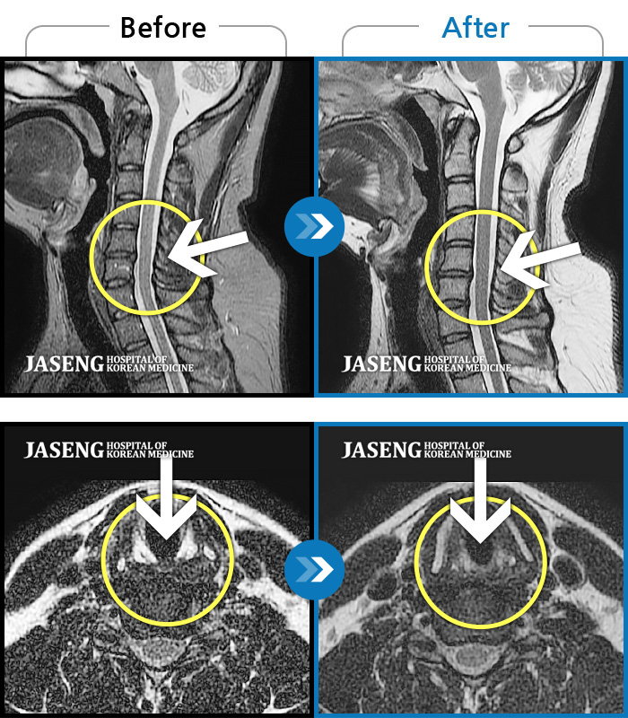 자생한방병원 치료사례 MRI로 보는 치료결과-팔 통증이 너무 심해서 잠을 잘 수가 없어요