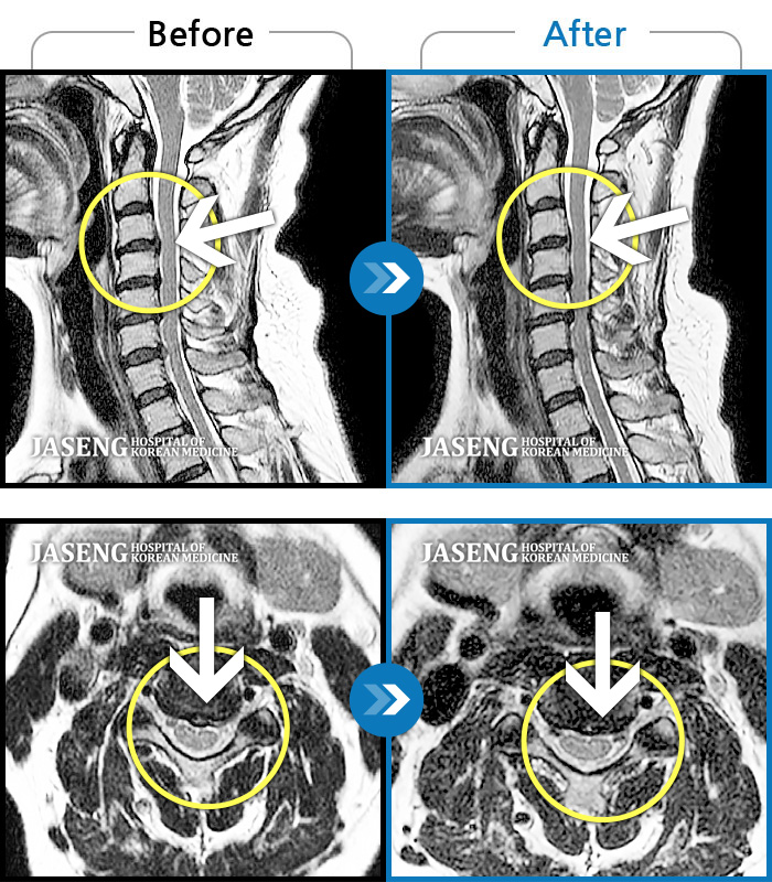 자생한방병원 치료사례 MRI로 보는 치료결과-컴퓨터 작업 후 목 통증이 심해 일상 생활이 불가능