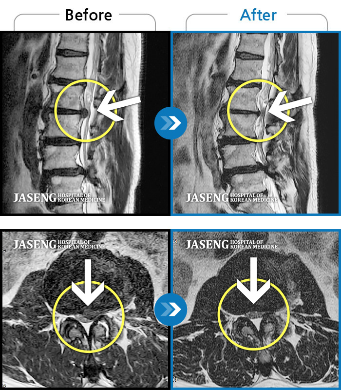 자생한방병원 치료사례 MRI로 보는 치료결과-신경 치료 이후 왼쪽 무릎이 뚝 하는 소리와 함께 통증 심화