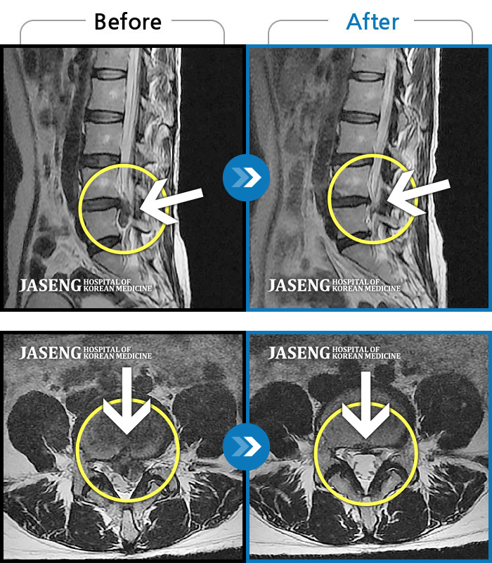 자생한방병원 치료사례 MRI로 보는 치료결과-처음 내원 시 허리, 엉덩이가 많이 아프고, 좌측 다리에 힘이 빠지며 감각이 둔하여 정상적인 보행이 힘든 상태셨습니다. 