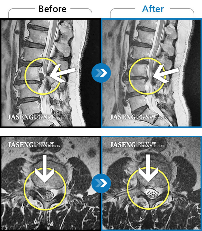 자생한방병원 치료사례 MRI로 보는 치료결과-극심한 요통 및 하지방사통으로 보행이 어려워 일상생활이 불가능한 상태로 내원하셨습니다.