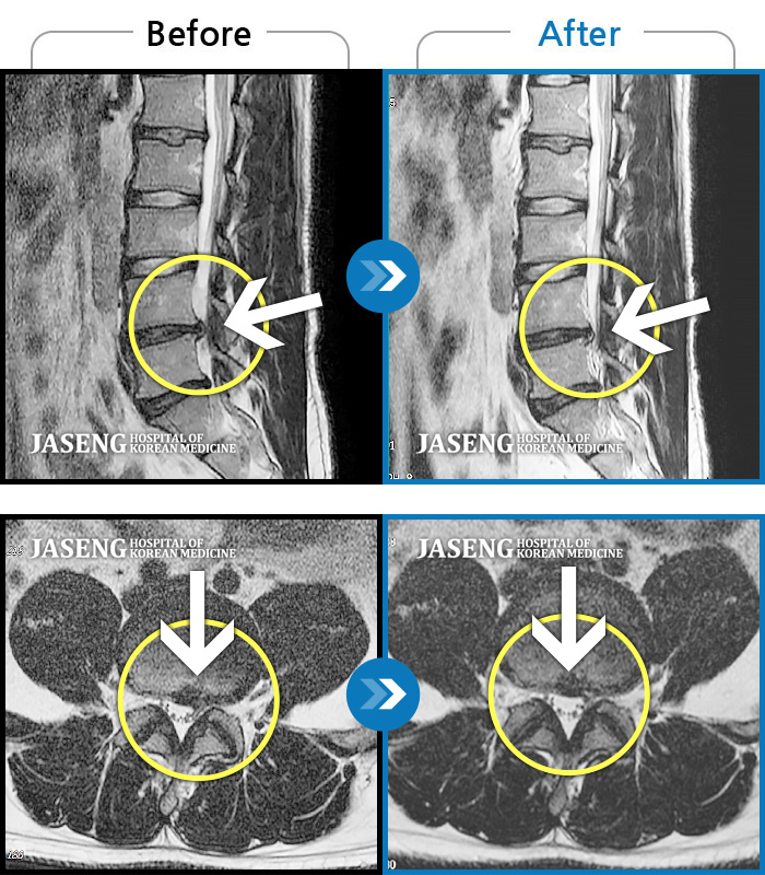 자생한방병원 치료사례 MRI로 보는 치료결과-허리 통증과 좌측 골반 통증으로 업무시 불편해요
