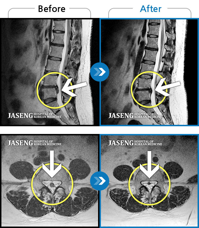 자생한방병원 치료사례 MRI로 보는 치료결과-허리를 숙이기도 힘들고 우측 다리까지 증상이 내려와요