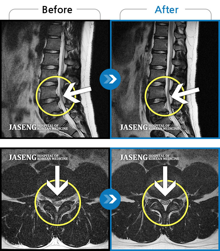 자생한방병원 치료사례 MRI로 보는 치료결과-우측 엉치에서 다리 뒤쪽으로 당기는 통증