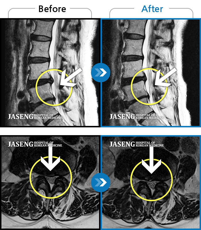 자생한방병원 치료사례 MRI로 보는 치료결과-허리 숙일 때 통증이 심하고 엉치가 시려요
