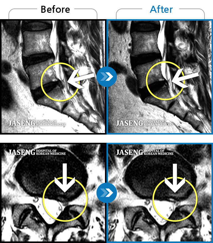 자생한방병원 치료사례 MRI로 보는 치료결과-좌측 다리 저림 증상이 너무 심하여 앉거나 서는 것이 안되고 다리를 들어올릴 수 가 없었다. 