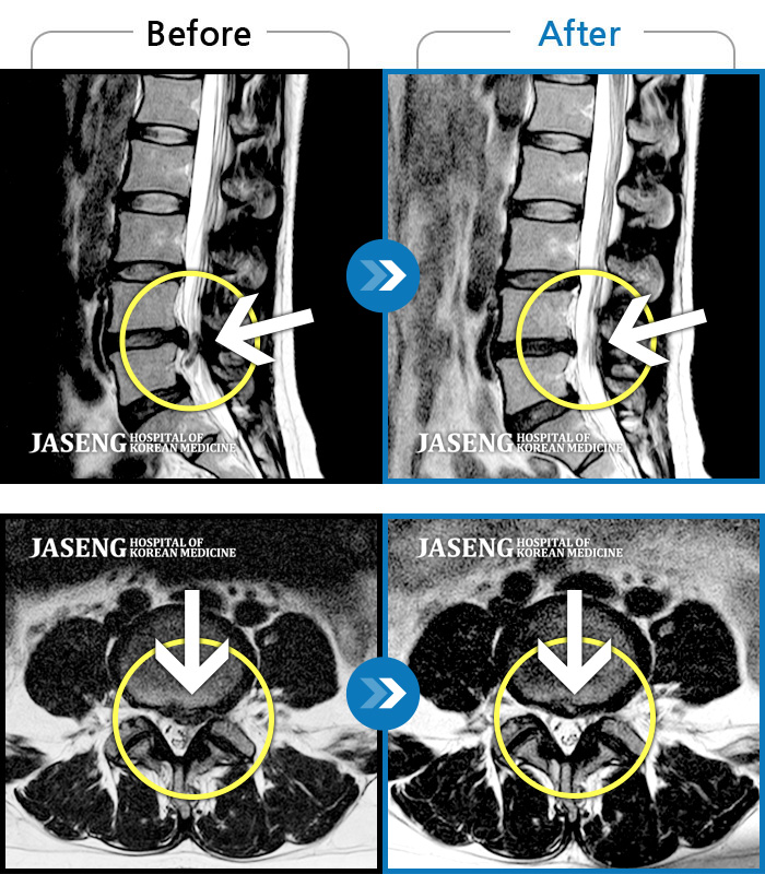 자생한방병원 치료사례 MRI로 보는 치료결과-요통 및 다리통증이 매우 심해 움직이기 어려운 상태였습니다.
