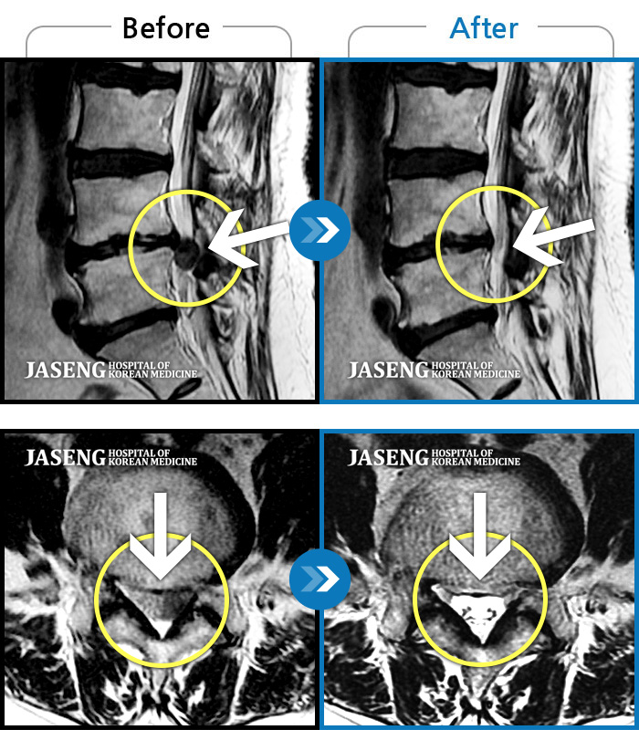 자생한방병원 치료사례 MRI로 보는 치료결과-화장실 청소를 한 후 좌측 골반통증 및 좌측 엄지발가락 얼얼함, 근력저하가 있었다.