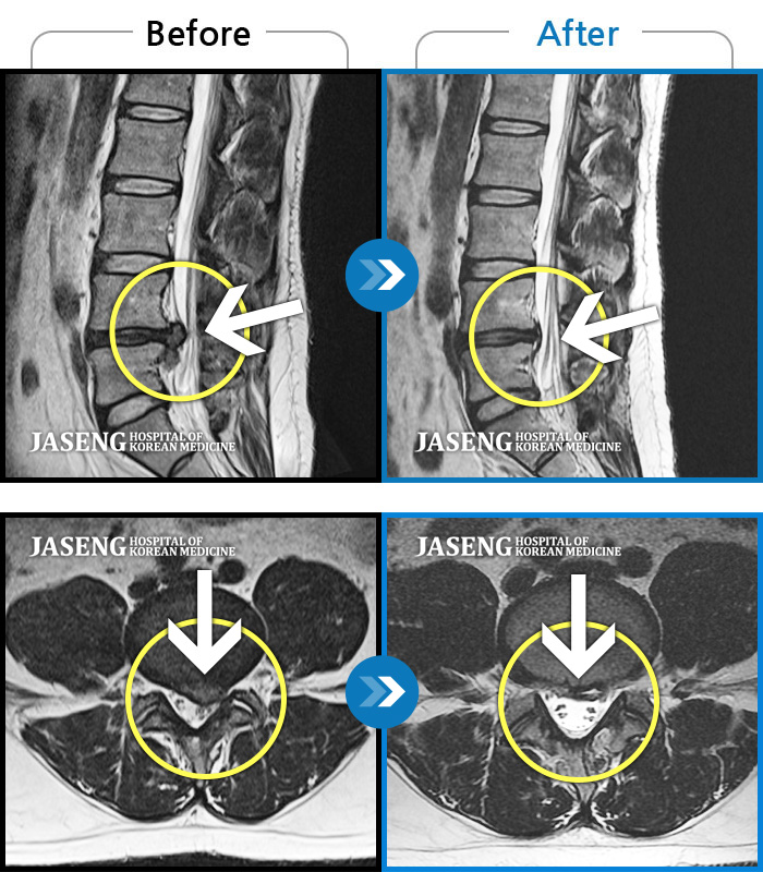 자생한방병원 치료사례 MRI로 보는 치료결과-허리와 골반이 아프고, 좌측 다리에 통증과 저림이 있었다.