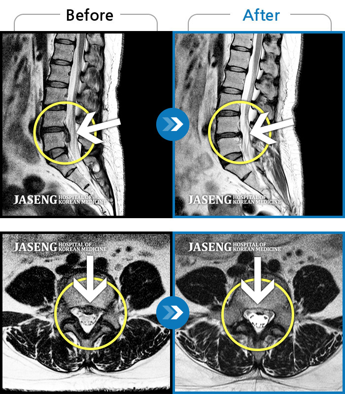 자생한방병원 치료사례 MRI로 보는 치료결과-극심한 허리 통증과 다리의 근력 약화로 거동이 힘든 상태로 내원하였습니다.
