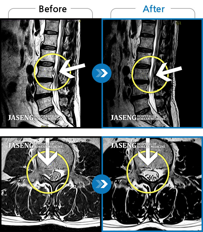 자생한방병원 치료사례 MRI로 보는 치료결과-우측 허리부터 골반 통증, 우측 다리까지 이어지는 저림감, 10분이상 앉아있기 어려움