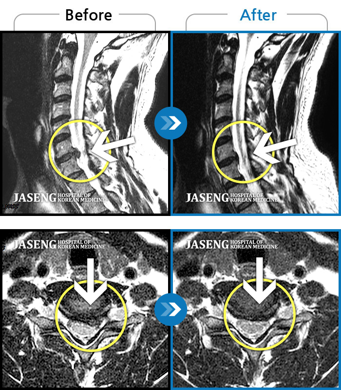 자생한방병원 치료사례 MRI로 보는 치료결과-좌측 목 통증과 좌측 팔저림이 심해서 업무가 힘들었습니다.