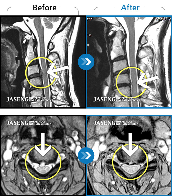 자생한방병원 치료사례 MRI로 보는 치료결과-양측 승모근 통증과 목 통증, 견갑골 통증으로 고개를 돌릴때 통증을 호소하는 환자였습니다.
