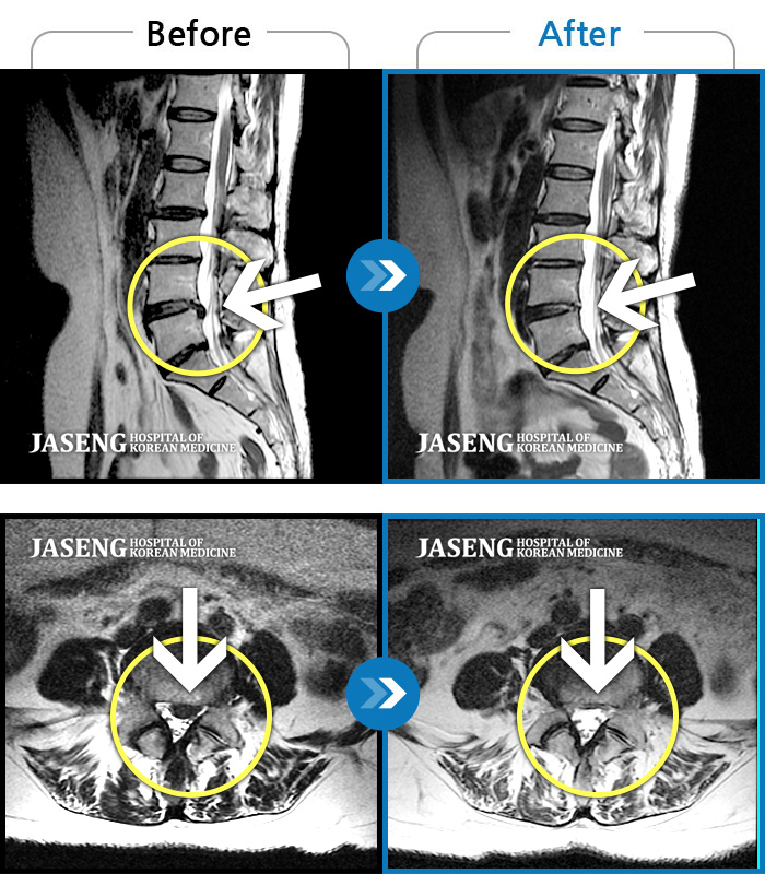 자생한방병원 치료사례 MRI로 보는 치료결과-발목의 힘이 떨어져서 절뚝거리면서 걸었다.