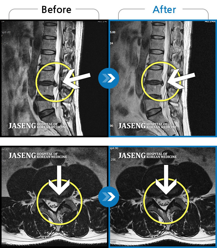 자생한방병원 치료사례 MRI로 보는 치료결과-좌측요통 좌측하지방사통으로 타병원에서 8회 주사치료 후 호전 없어서 내원
