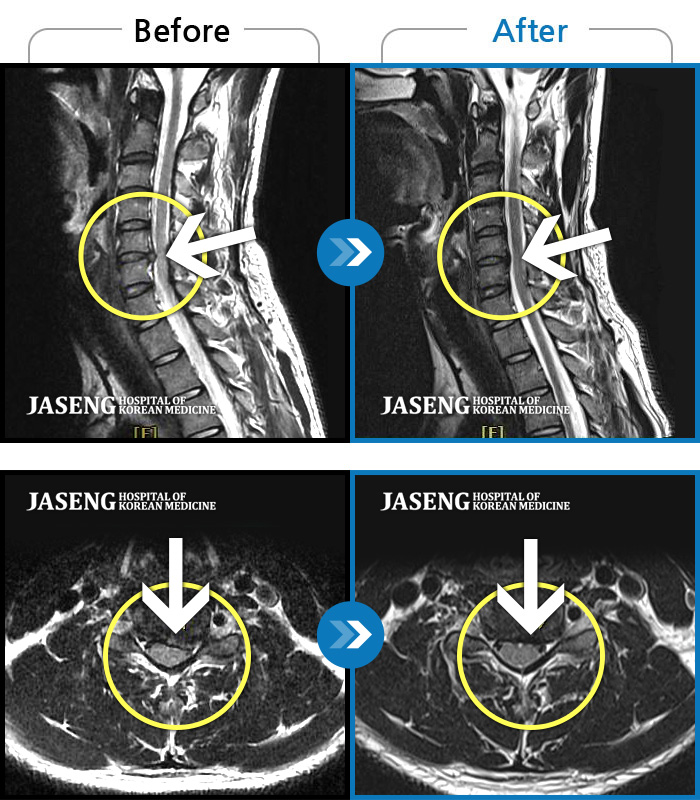 자생한방병원 치료사례 MRI로 보는 치료결과-좌측 승모근부터 견갑골까지 이어지는 통증, 좌측 상완 비증으로 내원하셨습니다.