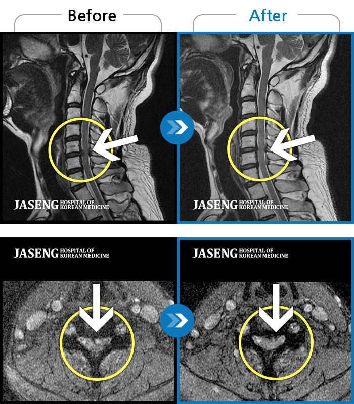 자생한방병원 치료사례 MRI로 보는 치료결과-교통사고로 인해 기존의 퇴행성 디스크가 파열되어 극심한 경추의 통증과 손의 힘 빠짐,  손가락의 저림 증상을 호소하였음 