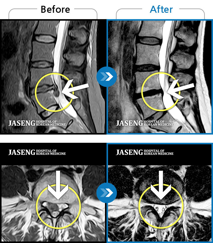 자생한방병원 치료사례 MRI로 보는 치료결과-요추 디스크 파열로 극심한 통증을 동반하여 내원하였습니다