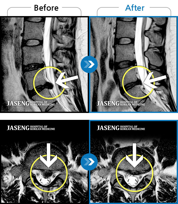 자생한방병원 치료사례 MRI로 보는 치료결과-좌측 다리 저림이 매우 심해 야간통증 및 일상 생활에 제한이 많은 상태로 내원하였습니다.