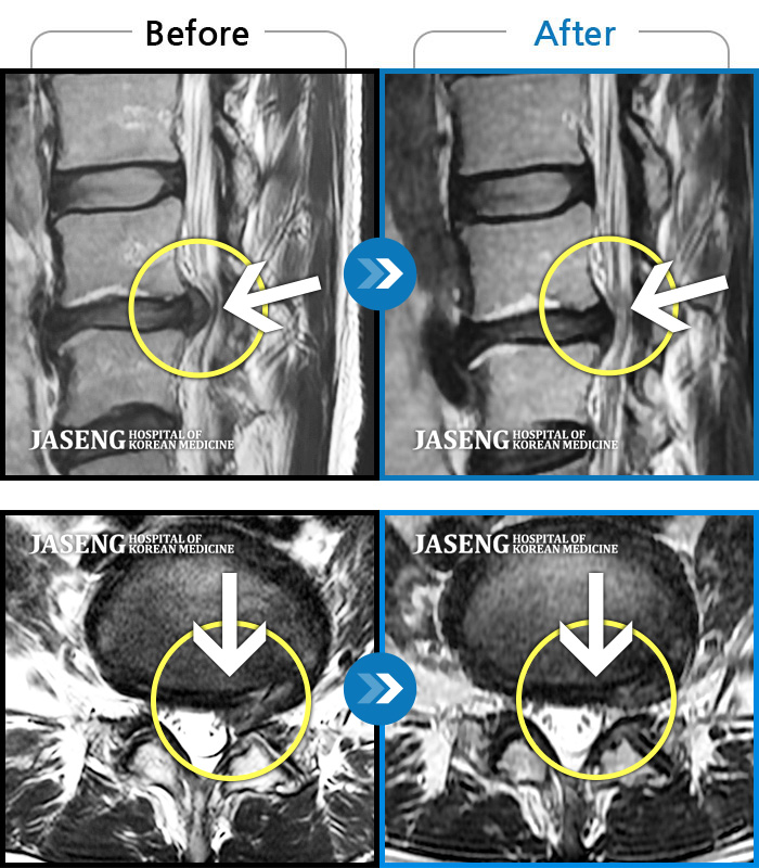 자생한방병원 치료사례 MRI로 보는 치료결과-왼쪽 허리와 종아리가 저리고 발 감각이 둔해졌어요.