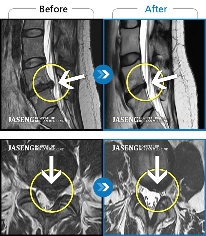 자생한방병원 치료사례 MRI로 보는 치료결과-처음 내원 시 좌측 허리 뻐근한 통증과 좌측 허벅지부터 발가락까지 이어지는 당기고 저린 증상으로 보행까지 불편감 호소하시며 내원하신 환자입니다.