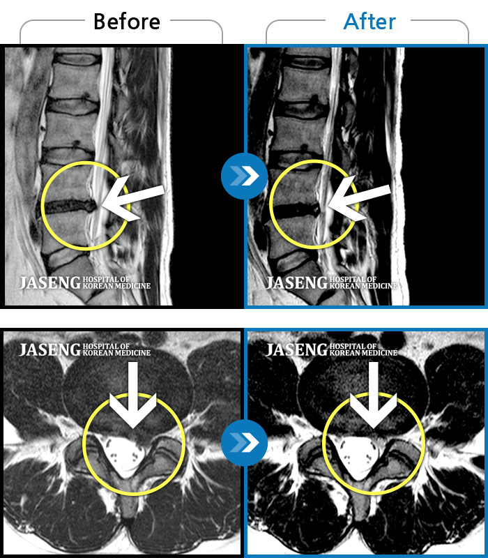 자생한방병원 치료사례 MRI로 보는 치료결과-기존에 약했던 허리 디스크가 다시 터졌어요