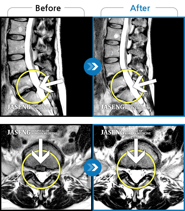 자생한방병원 치료사례 MRI로 보는 치료결과-오래 전부터 안 좋던 허리가 최근에 더 많이 심해졌어요