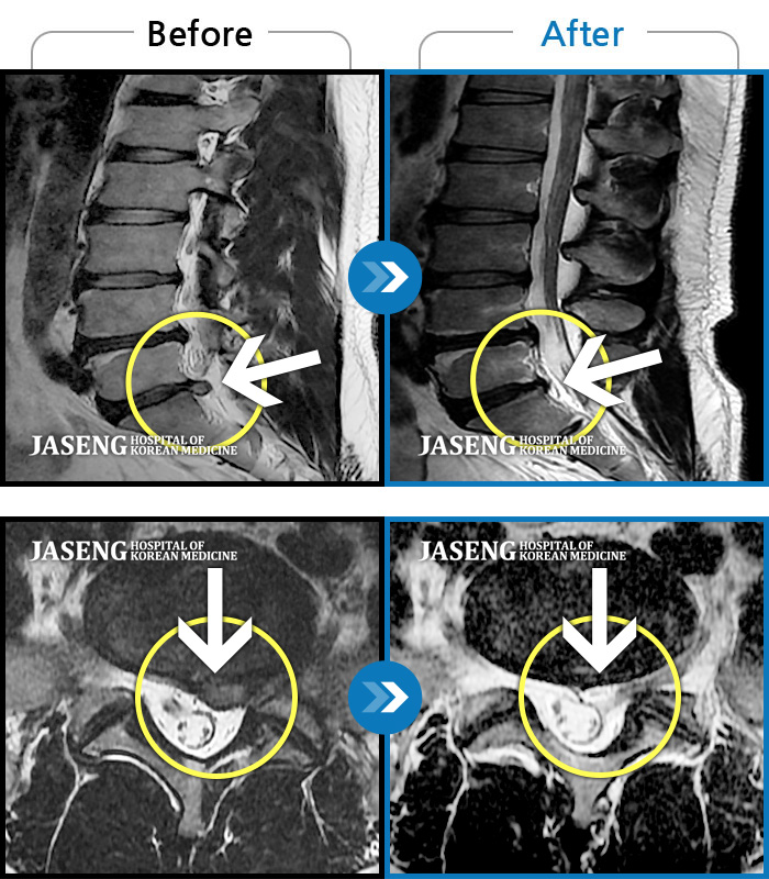 자생한방병원 치료사례 MRI로 보는 치료결과-하지 저림과 통증이  개선되어서 일상생활이 너무 즐겁습니다.