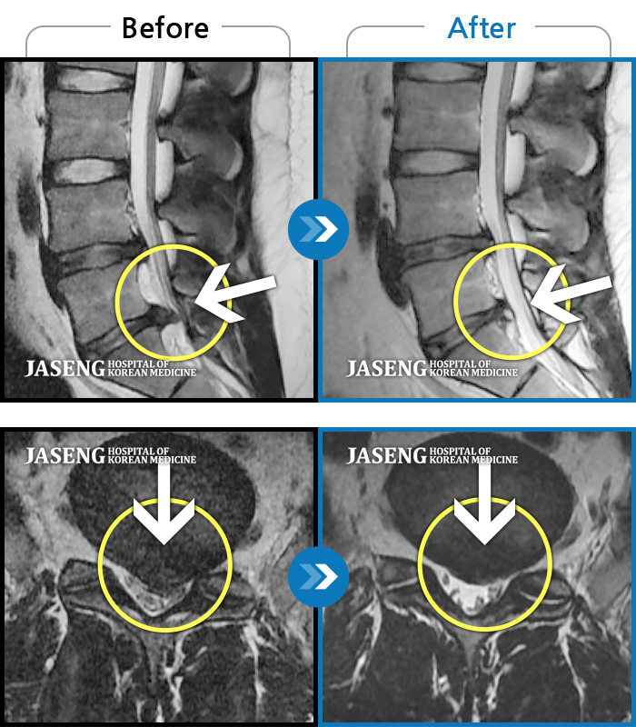 자생한방병원 치료사례 MRI로 보는 치료결과-기침하다가 주저앉았어요. 지금은 양측 다리가 당겨요.