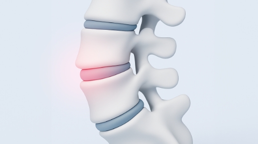 휘거나 틀어진 척추뼈