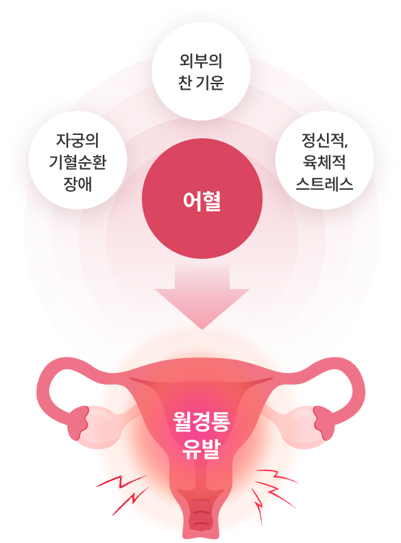자궁의기혈순환장애,외부의 찬 기운, 정신정,육체적 스트레스 어혈 월경통유발