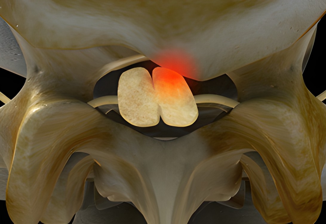 (2개월 이상) 협착증, 퇴행성디스크 등 중증 척추 질환