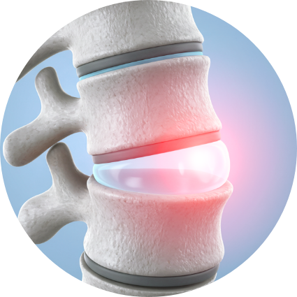신경 유착 그래픽