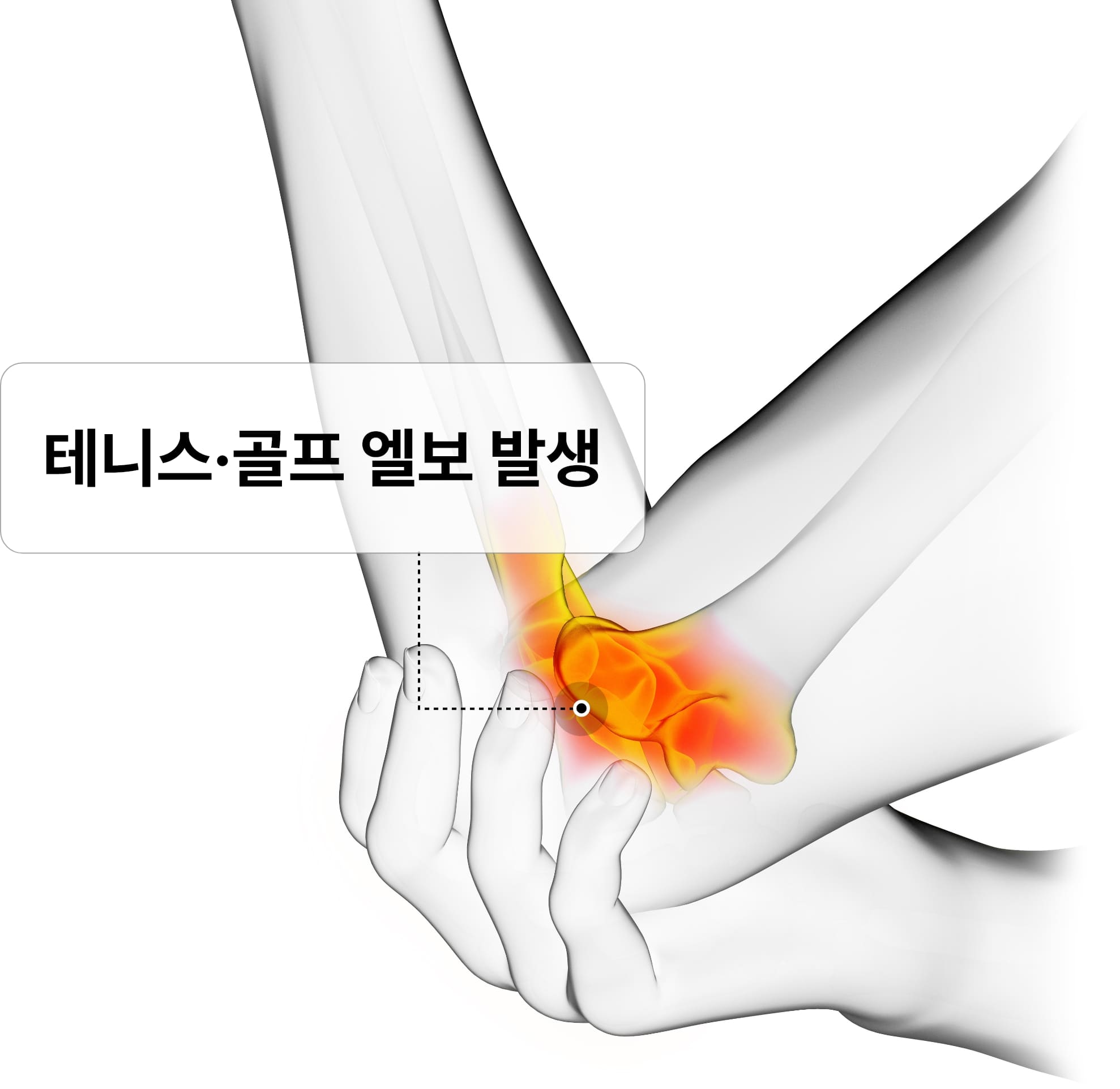 테니스·골프 엘보 발생