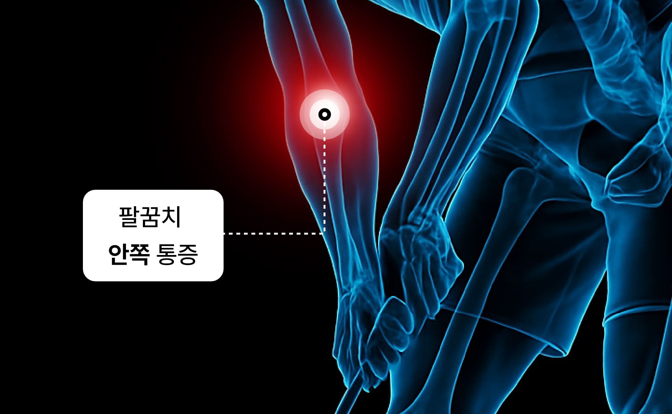 골프 엘보-팔꿈치 안쪽 통증